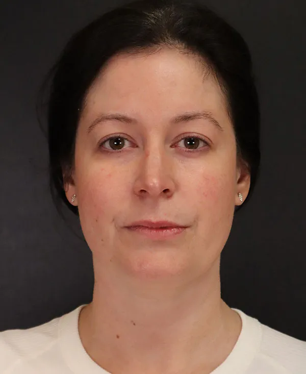 front view before submental liposuction by Daniela Atencio MD